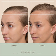 VEGAMOUR GRO+: agujas 0,25 mm en acero inoxidable para exfoliar suavemente