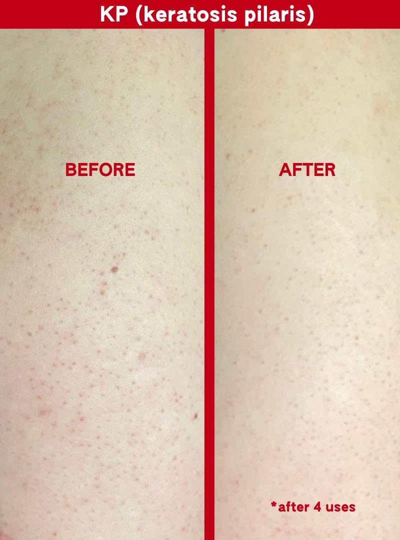 Piel radiante tras primer uso, exfoliante corporal Abi Ame para resultados visibles.