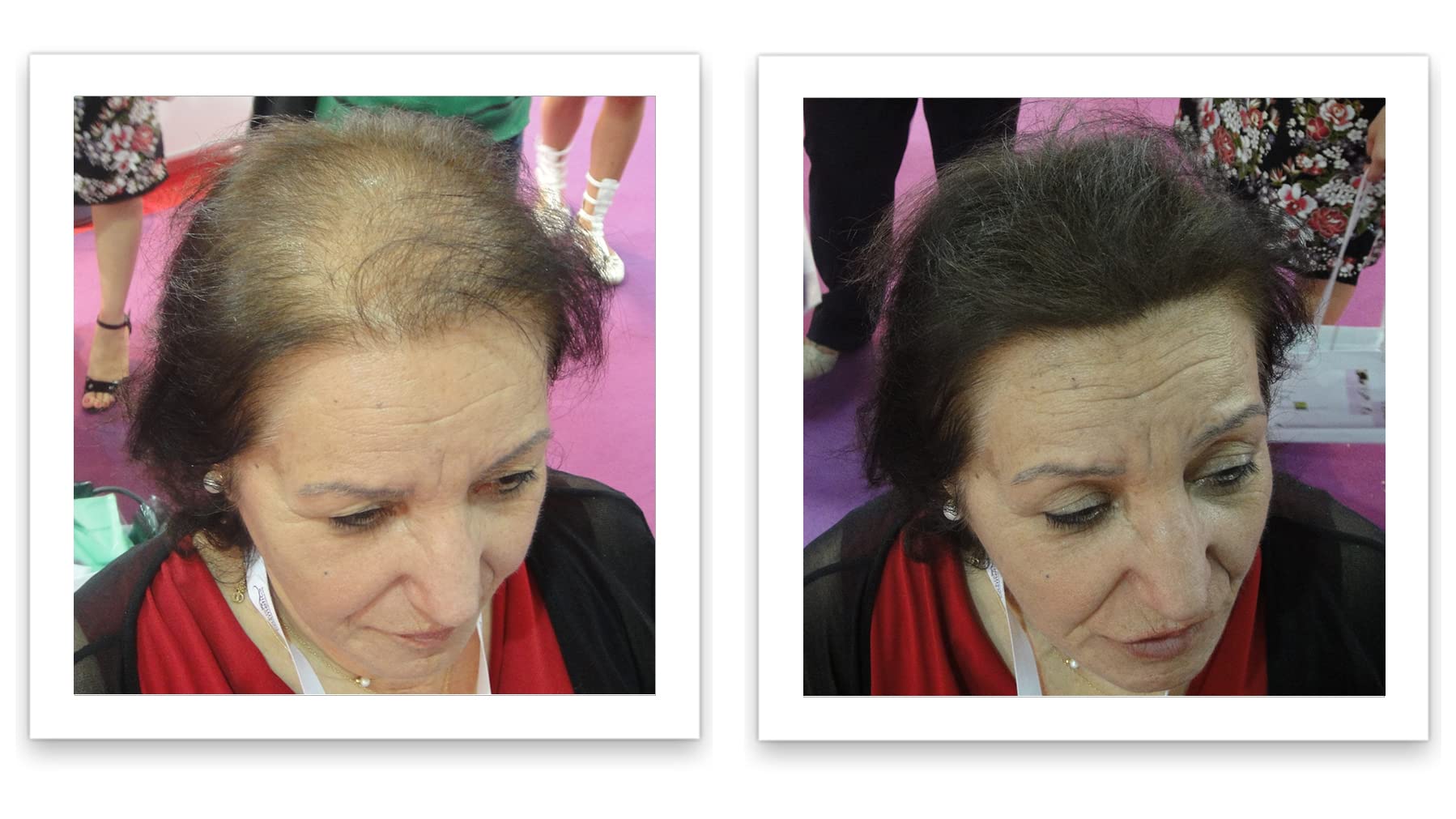 Aplicación de Caboki en la línea de cabello para mayor densidad visual.