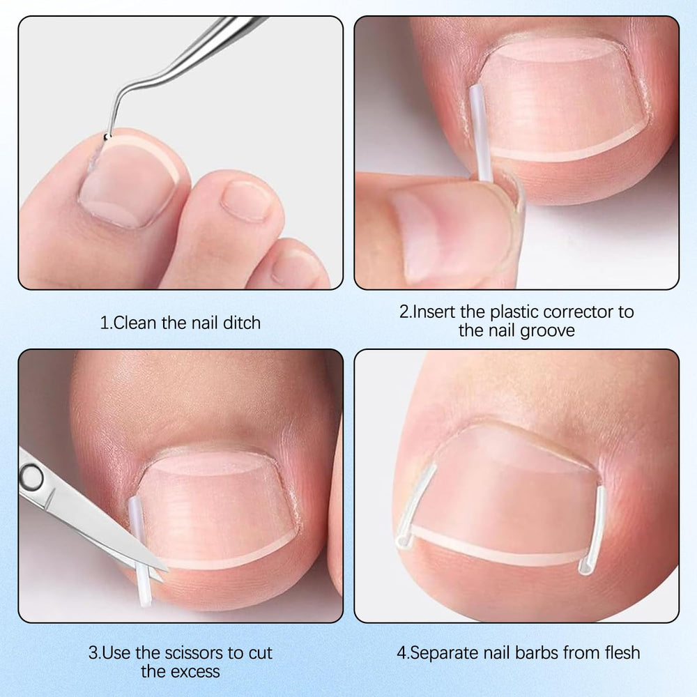 Conjunto Corrector Uñas Encarnadas: boligrafos-espaciadores para rellenar huecos entre uñas con facilidad