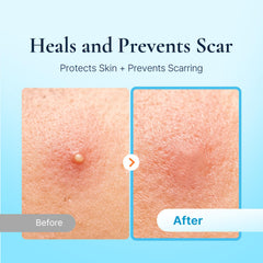 DERMAKR parche acne resistente al agua protege durante el dia