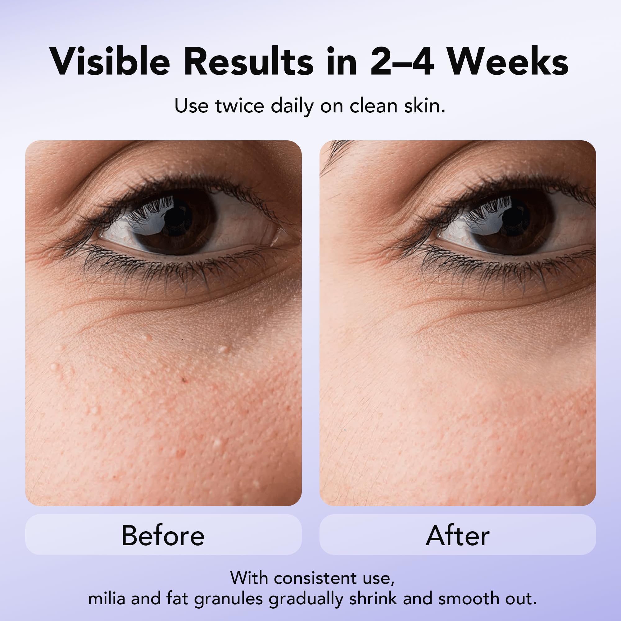 DERMFREE Milia Remover envase compacto facilita llevarlo contigo