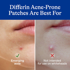 Close-up of Differin Acne Patches showing salicylic acid action on a blemish