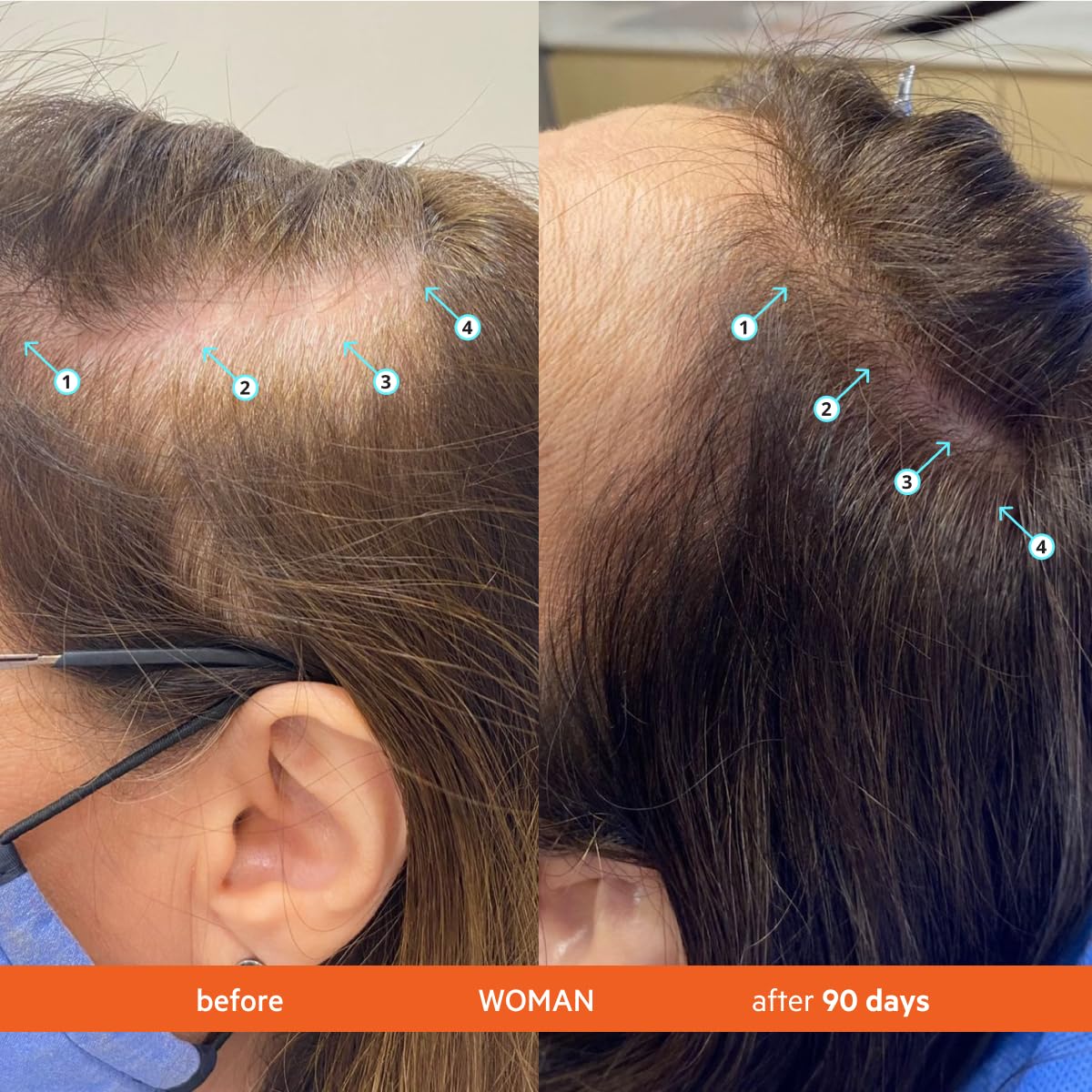 Revita Shampoo enfoque en densidad capilar, cabello con aspecto más voluminoso.