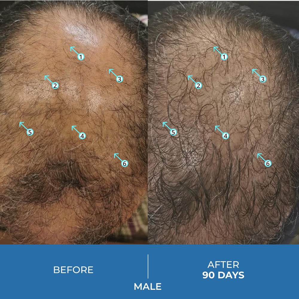 DS Laboratories Spectral.UHP minoxidil 5% en acción, soporte de aspecto de cabello más pleno.