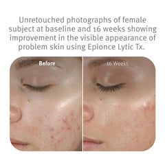 Epionce Lytic Tx: poros más limpios con irritación reducida.