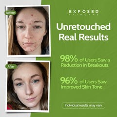 Label close-up highlights 1 percent salicylic acid and natural extracts.