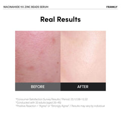 FRANKLY Niacinamida 15% + Zinc, aplicación suave del serum para textura uniforme