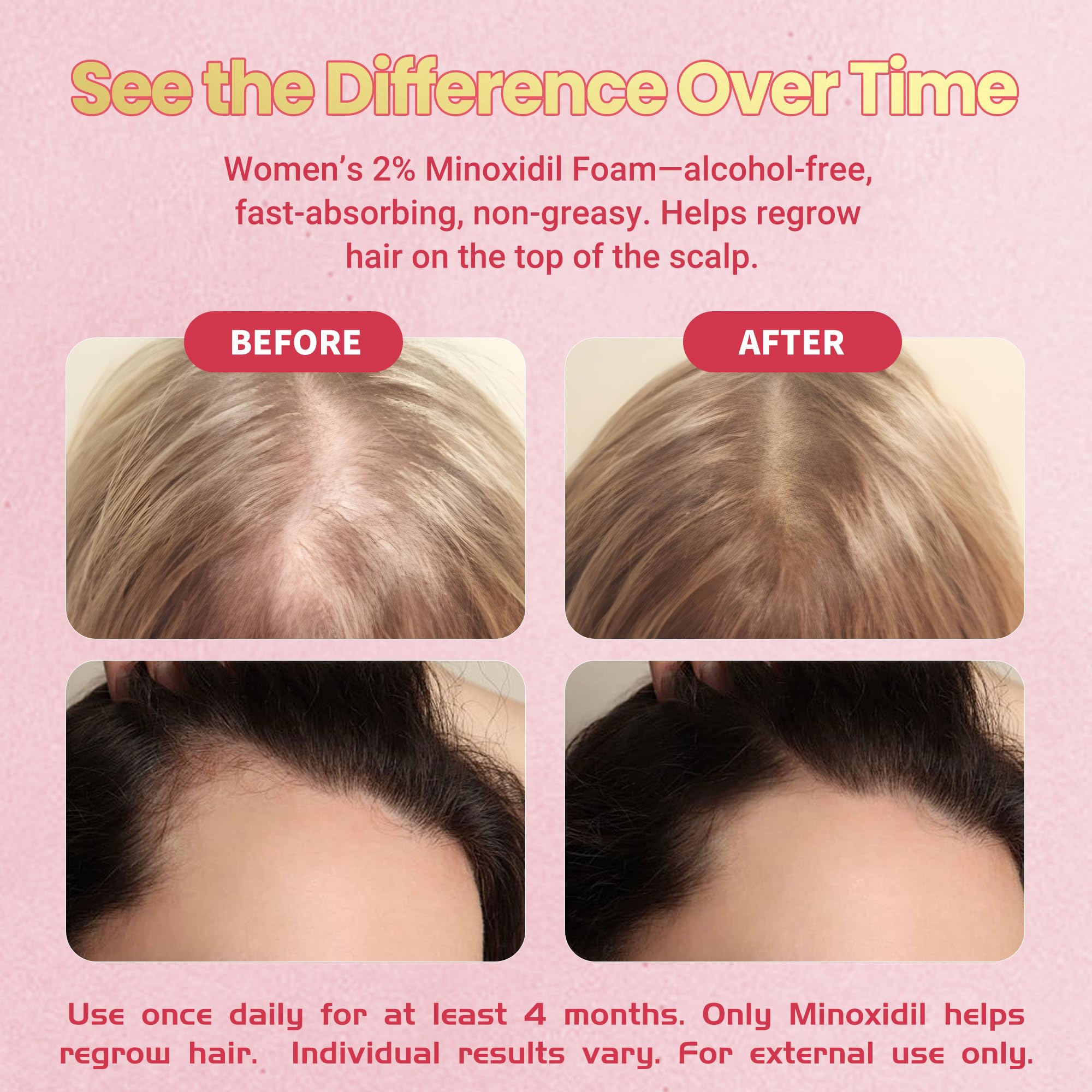 Minoxidil Foam de Gemächlich Zu Hause: ingredientes Active Care para cuidado del cuero cabelludo