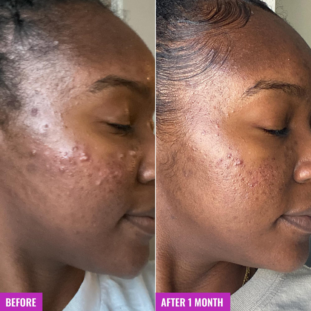Good Molecules Acne Foaming Cleanser witch hazel aloe graphic conveys soothing care.