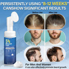 Greoay Minoxidil espuma, aplicación suave en manos para crecimiento