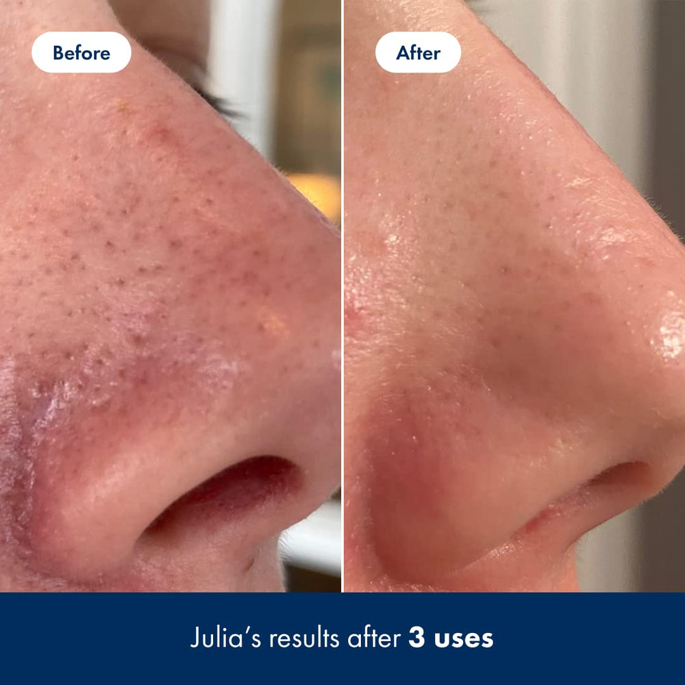 Hero Cosmetics Pore Release peut être utilisé sur la zone T.