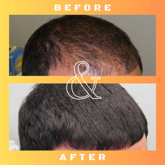 Mane Regain: bloqueo de DHT con RU58841 para preservar el cabello.