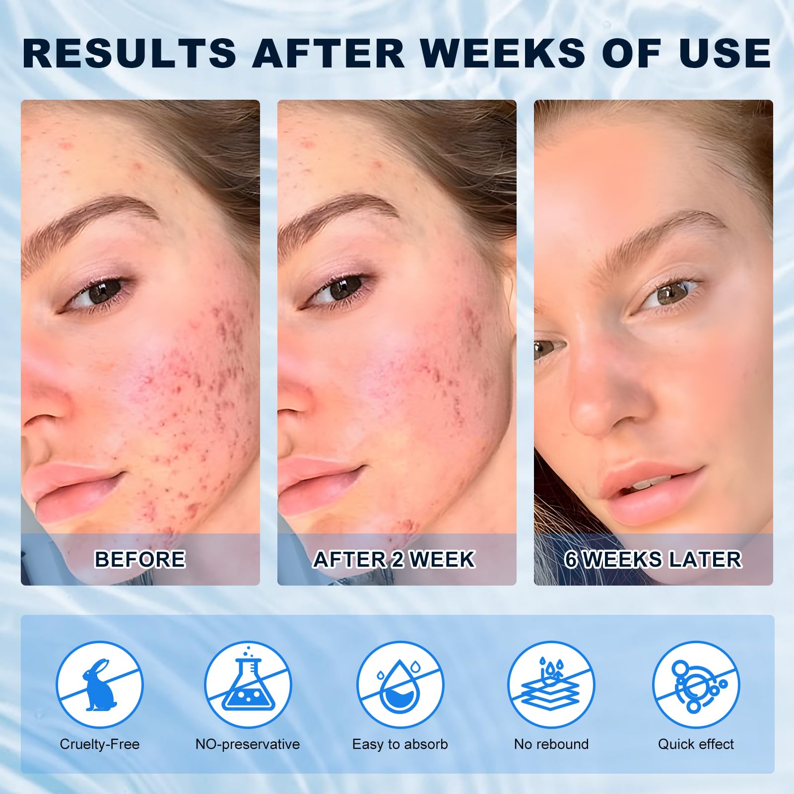 marianp crema ácido azelaico 10% reduce rojeces y enrojecimiento facial