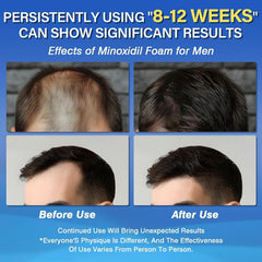 Aplicador de la espuma Minoxidil Olassubd para aplicación precisa y cómoda.