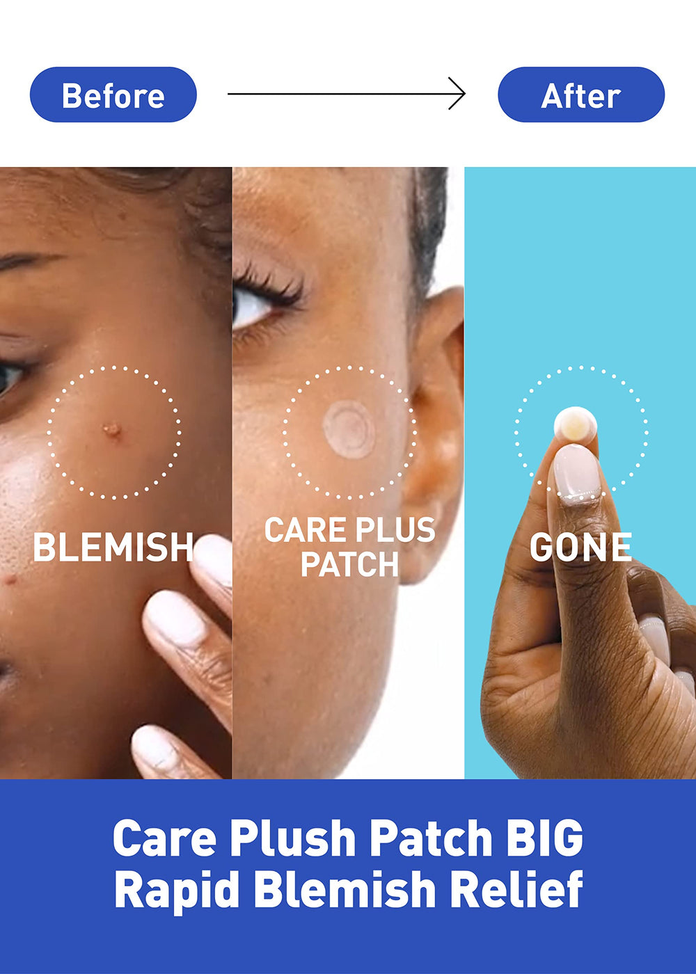 OLIVE YOUNG Care Plus Spot Patch Cobertura invisible para uso diario.