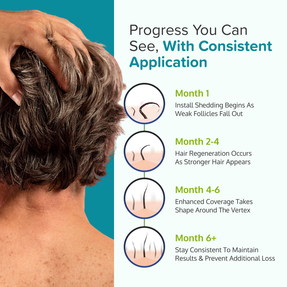 Suministro de 6 meses de Minoxidil 5% para hombres