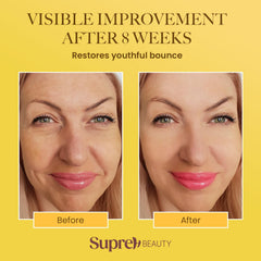 Aplicación en rostro con SupreH, lifting suave para líneas finas.