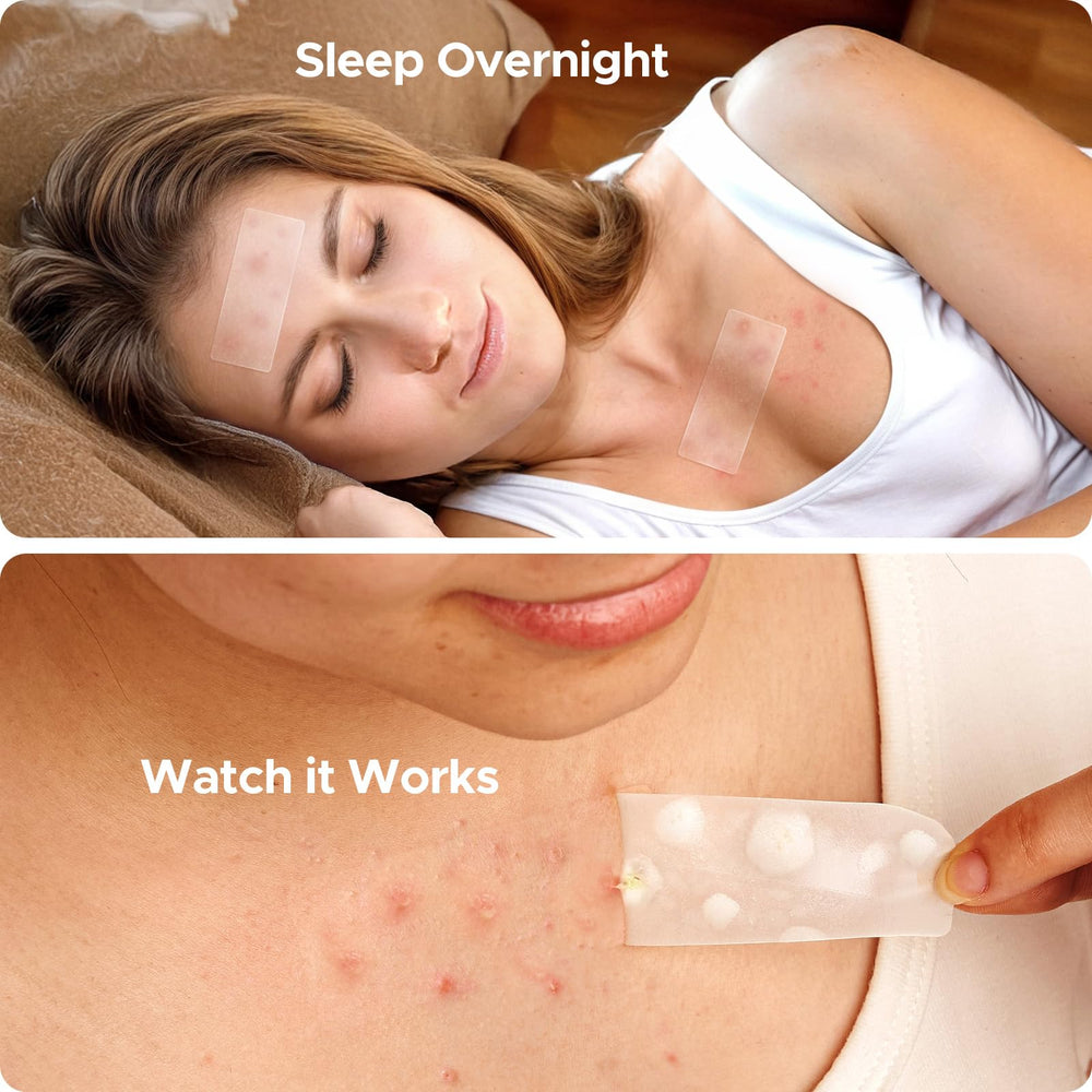Parche TKTK para acne en el pecho, solución discreta para áreas amplias.